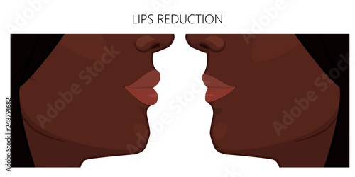 Vector illustration. African American Lips reduction before and after procedure. Close up view. For advertising of medicinal, pharmacy products, cream, lotion, cosmetic and plastic procedures.