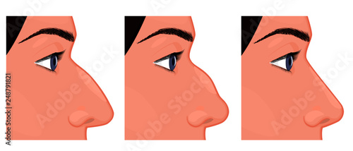 Vector illustration. Side view of a human nose before, after aesthetic plastic surgery - rhinoplasty (nose job). Close up view. For advertising, medical and beauty publications.
