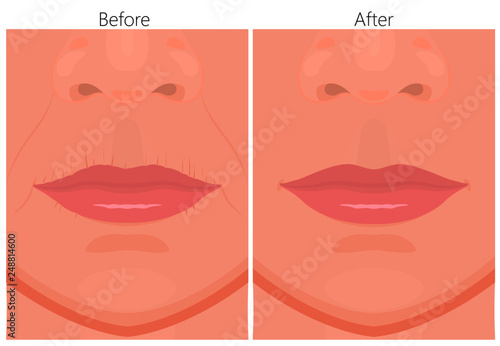 Vector illustration of upper-lip wrinkles removal before and after plastic surgery or cosmetic procedure. For advertising and beauty publications.