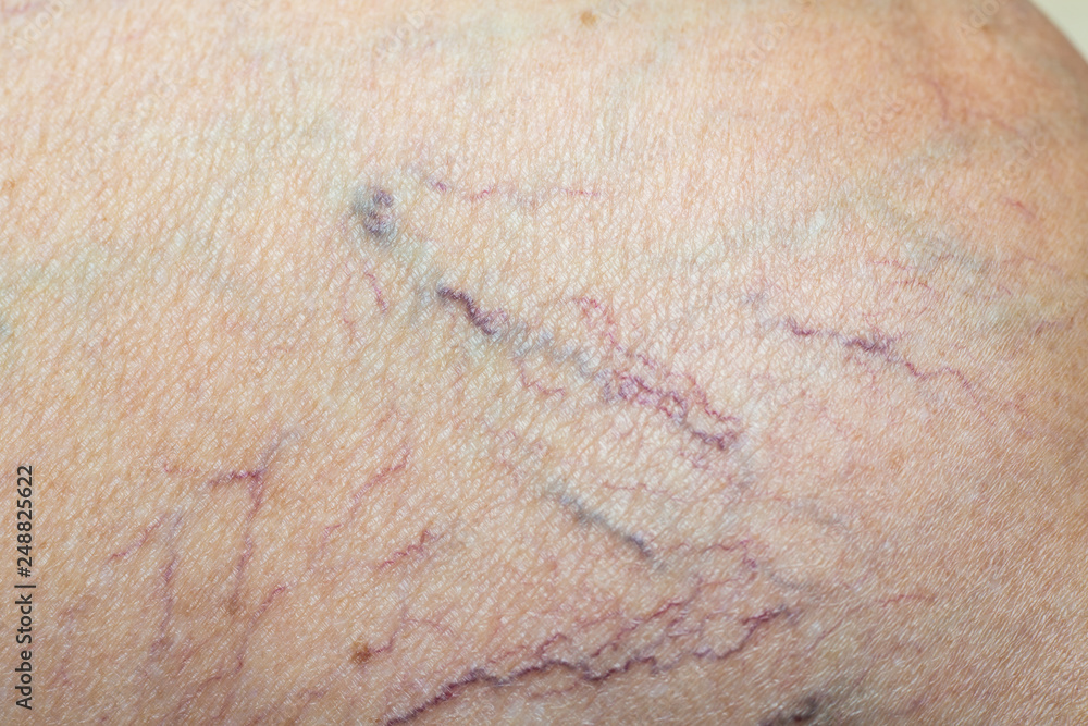 Fototapeta premium Varicose veins on a leg in Senior women, Close up & Macro shot, Selective focus, Asian body skin part, Healthcare concept