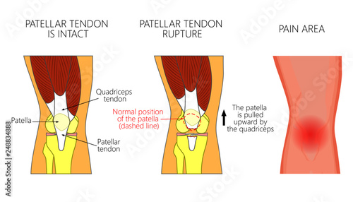 Vector illustration of a healthy knee joint and an unhealthy knee with a patellar tendon rupture problem. Anatomy, front view of the human knee.  For advertising and medical publications photo