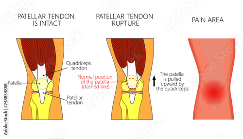 Vector illustration of a healthy knee joint and an unhealthy knee with a patellar tendon rupture problem. Anatomy, front view of the human knee.  For advertising and medical publications