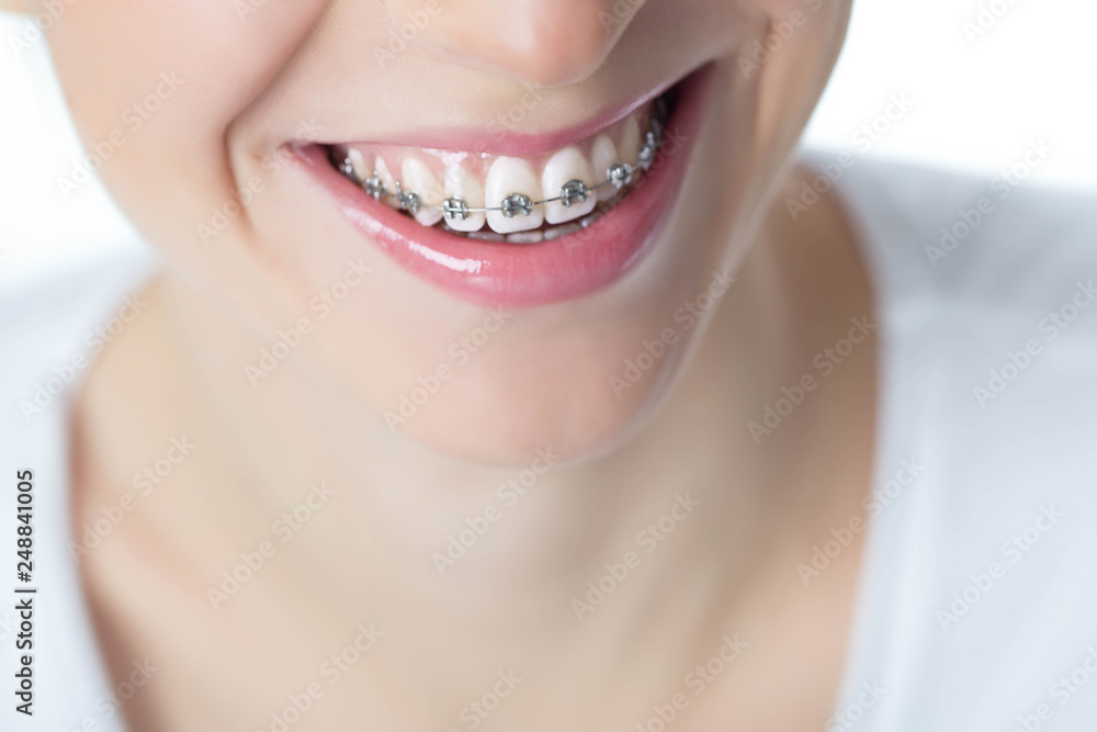 Obraz premium Woman with braces 