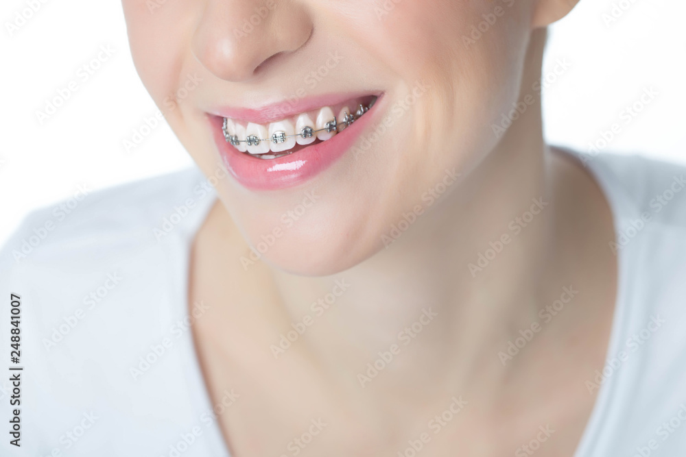 Obraz premium Woman with braces 