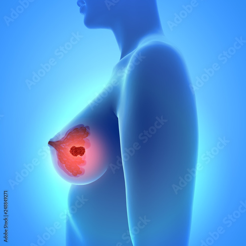 3d illustration of breast cancer - Mammakarzinom
