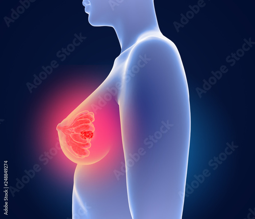 3d illustration of breast cancer - Mammakarzinom