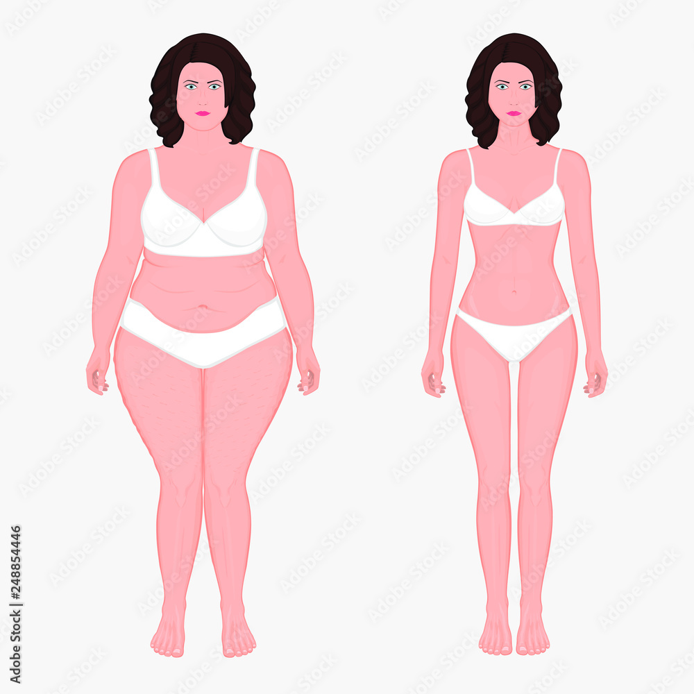 Vector illustration body weight loss in a European woman from obesity to normal. Front view. For advertising of cosmetic plastic procedures, stomach shunting, diet; medical publications Vector illustration body weight loss in a European woman from obesity to normal. Front view. For advertising of cosmetic plastic procedures, stomach shunting, diet; medical publications