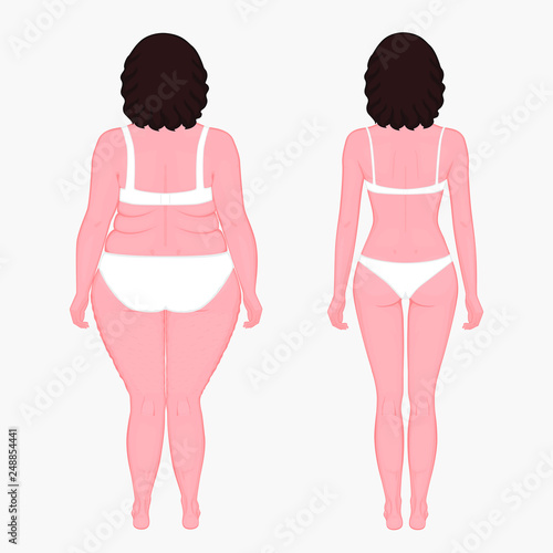 Vector illustration body weight loss in a European woman from obesity to normal. Back view. For advertising of cosmetic plastic procedures, stomach shunting, diet; medical publications