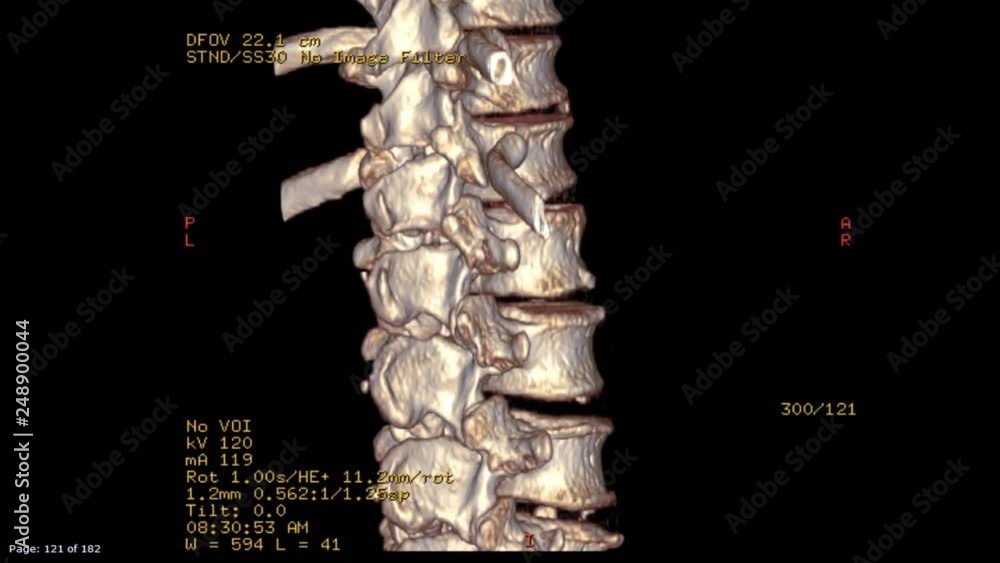 CT scan image of thoracolumbral spine or t-l spine 3D rendering image ...