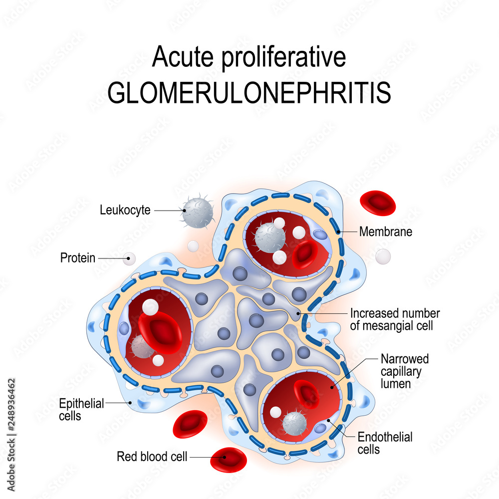 Acute proliferative glomerulonephritis. Stock Vector Adobe Stock