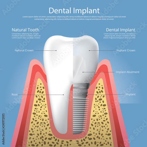 Human teeth and Dental implant Vector Illustration