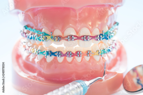 orthodontic model and dentist tool - demonstration teeth model of varities of orthodontic bracket or brace