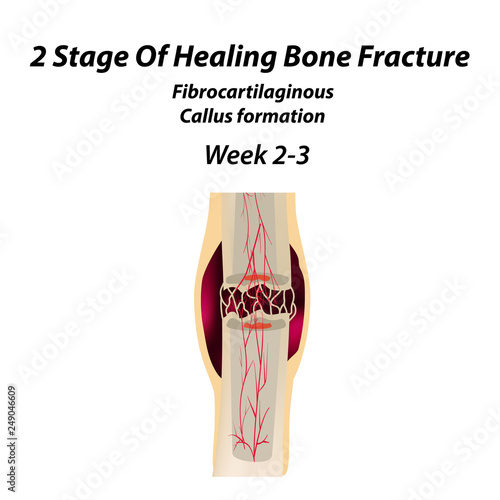 2 Stage Of Healing Bone Fracture. Formation of callus. The bone fracture. Infographics. Vector illustration on isolated background.