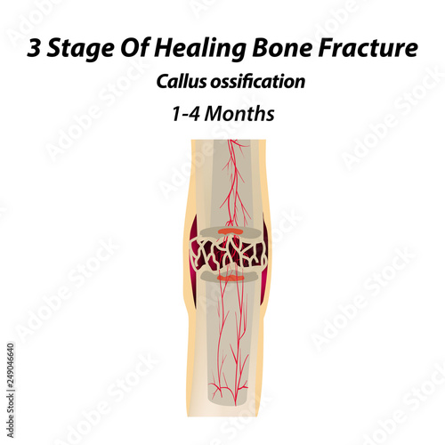 3 Stage Of Healing Bone Fracture. callus ossification. The bone fracture. Infographics. Vector illustration on isolated background.