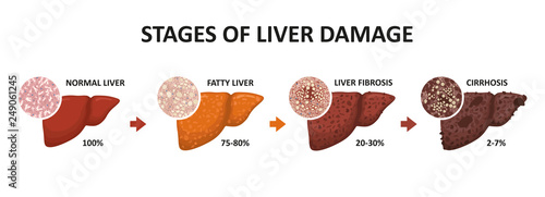 Stages of liver damage. Healthy, fatty, liver fibrosis and cirrhosis. photo