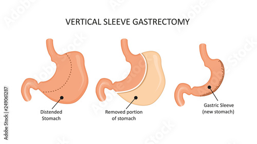 Vertical sleeve gastrectomy. Stomach reduction surgery