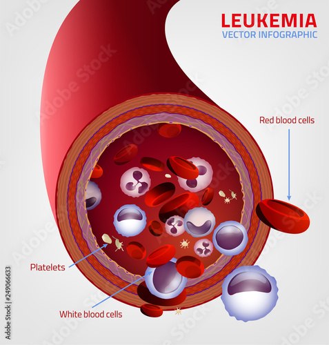 Leukemia medical infographic