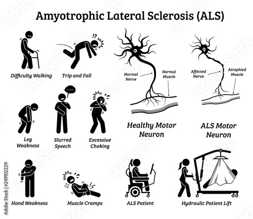 Amyotrophic lateral sclerosis ALS disease signs and symptoms. Illustrations depict nervous system or neurological disease in ALS patient.