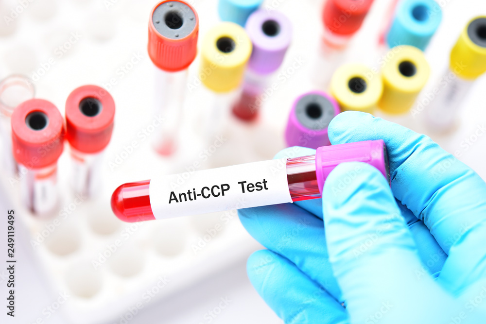 Blood sample tube for antiCCP test, diagnosis for rheumatoid arthritis disease Stock Photo