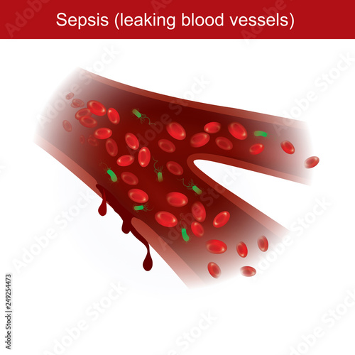 When the body has immune response to bacterial infections, causing inflammation and leaking blood vessels in the body.
