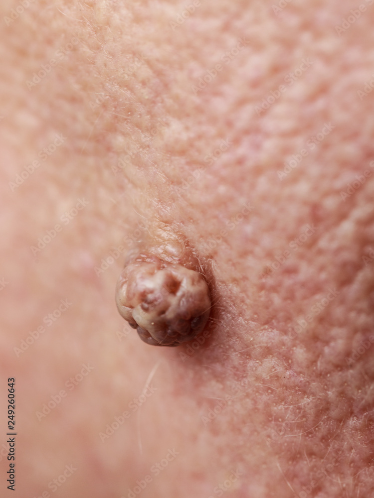 Fototapeta premium Elderly pensioner female, dermal fibroma closeup.
