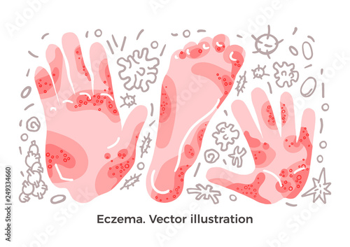 Vector set. Eczema, illness symptom, bacteria. Skin rashes on arm, hand. Art illustration