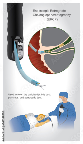 Endoscopic retrograde cholangiopancreatography (ERCP)