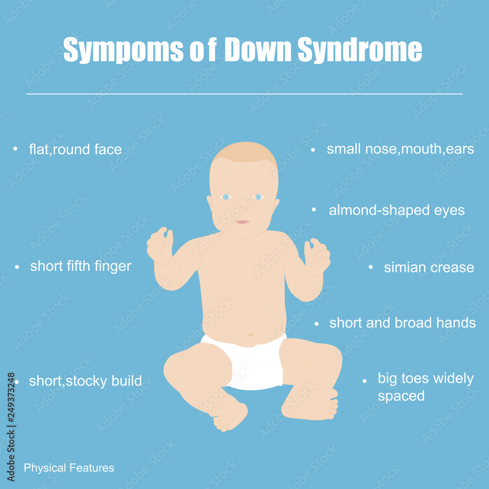 Down Syndrome Symptoms Baby Down Syndrome Symptoms Baby