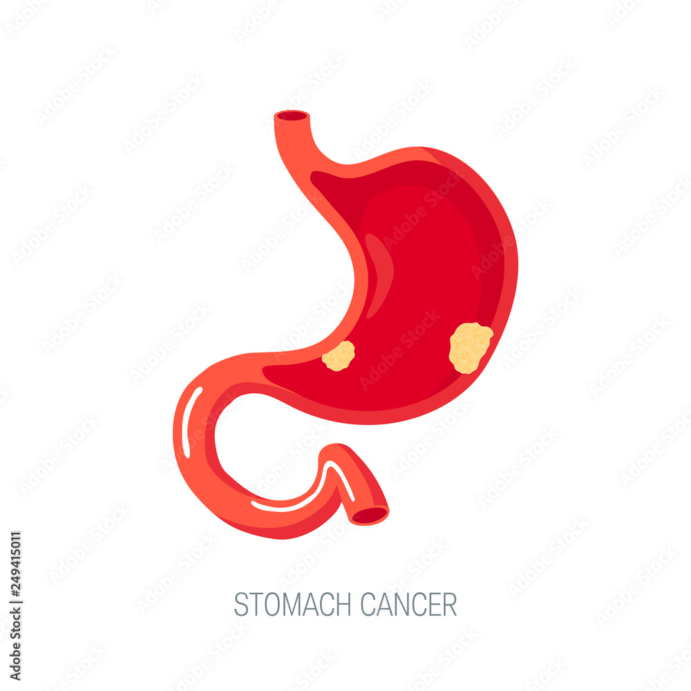 Gastric cancer concept in flat style, vector icon Gastric cancer concept in flat style, vector icon