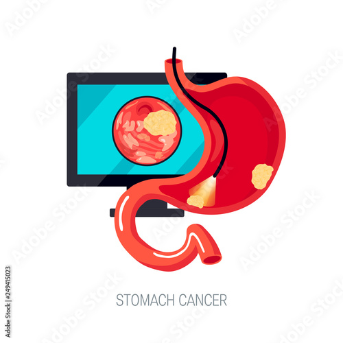 Gastric cancer concept in flat style, vector icon