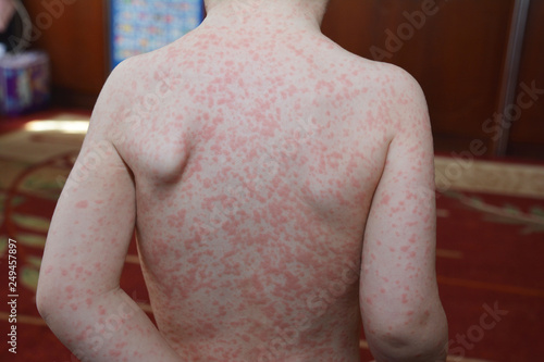 Close up on infectious mononucleosis (IM, mono), also known as glandular fever, herpesvirus is an infection usually caused by the Epstein–Barr virus (EBV). photo