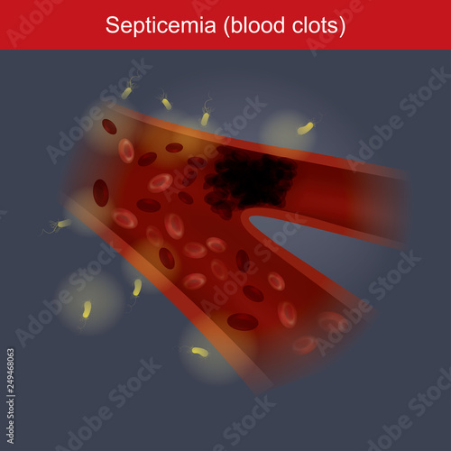 Septicemia.
