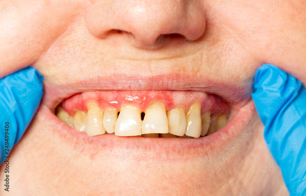 Fotografía teeth with periodontitis close up