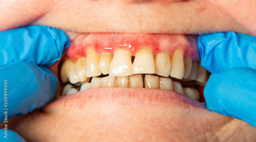 Fotografie teeth with periodontitis close up