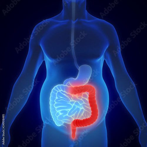 Картината върху платно 3D illustration showing Colitis ulcerosa - inflammatory bowel disease