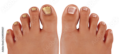 Φωτογραφία Onychomycosis