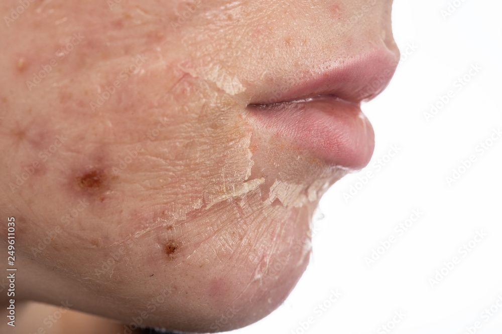 Fototapeta premium skin after peeling