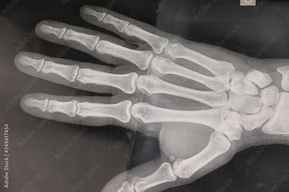 Radiographie de la main Stock Photo Adobe Stock