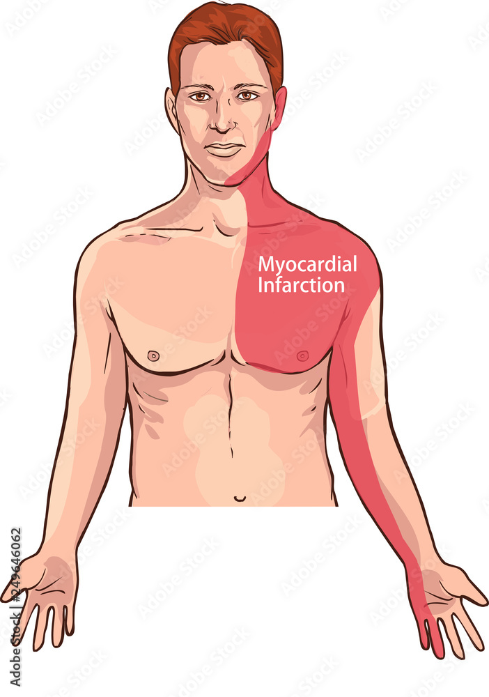 Vector Illustration Of A Heart Attack Pain Location Myocardial 