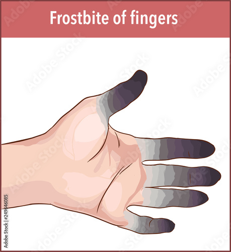 Vector illustration of a frostbite finger 