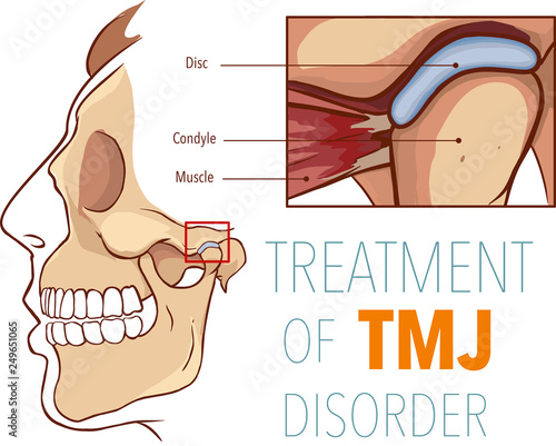 Vector illustration  of treatment of tmj disorder photo