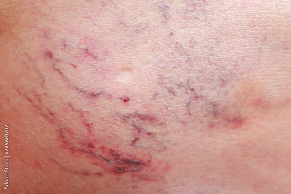 Fototapeta premium The varicose veins