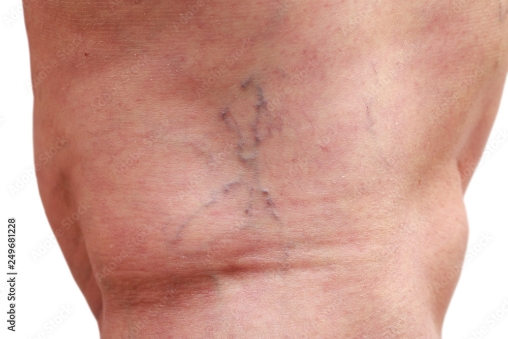 The varicose veins The varicose veins