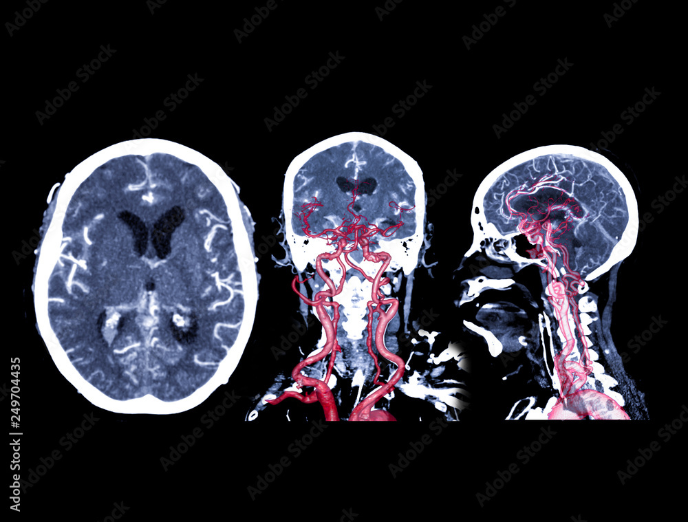 Collection of CT angiography of the brain or CTA brain comparison Axial ...
