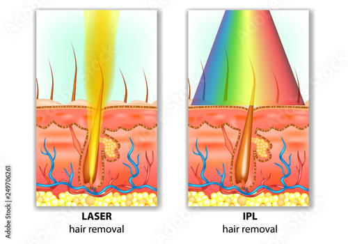 IPL (Intense Pulsed Light) and Laser Hair Removal. 