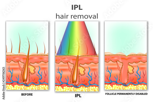 IPL (Intense Pulsed Light). How IPL Hair Removal Works photo
