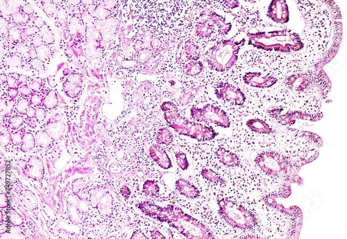 Histology of human tissue, show gastric mucosa intestinal metaplasia as seen under the microscope, 10x zoom