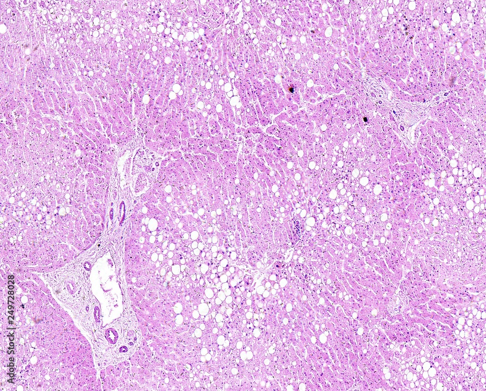 Histology of human tissue, show liver fatty degeneration as seen under ...