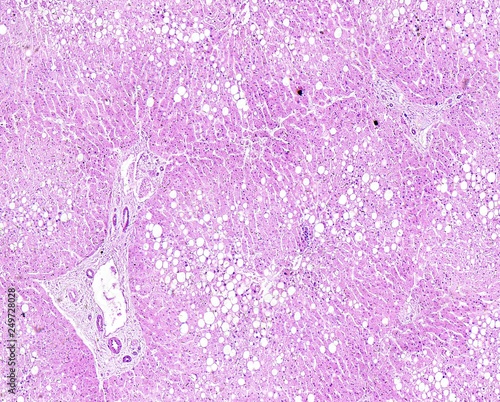 Histology of human tissue, show liver fatty degeneration as seen under the microscope, 10x zoom