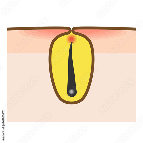 ムダ毛処理 脱毛トラブル毛嚢炎 毛包炎 のイラスト Stock イラスト Adobe Stock